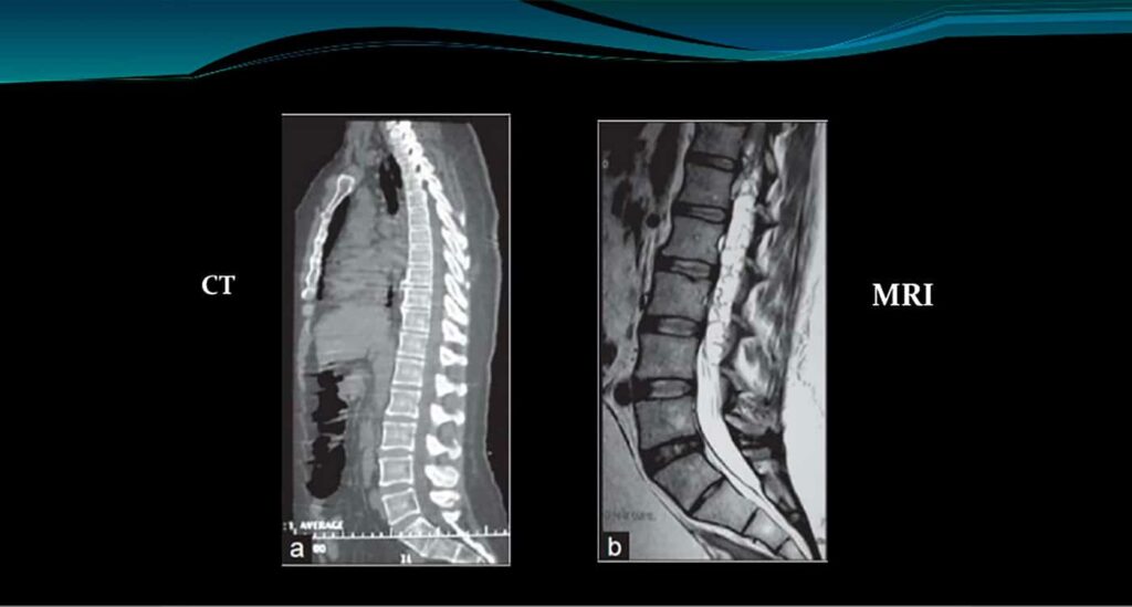 Ο ΡΟΛΟΣ ΤΗΣ CT ΚΑΙ MRI ΑΠΕΙΚΟΝΙΣΗΣ ΣΕ ΑΣΘΕΝΕΙΣ ΜΕ ΣΚΟΛΙΩΣΗ